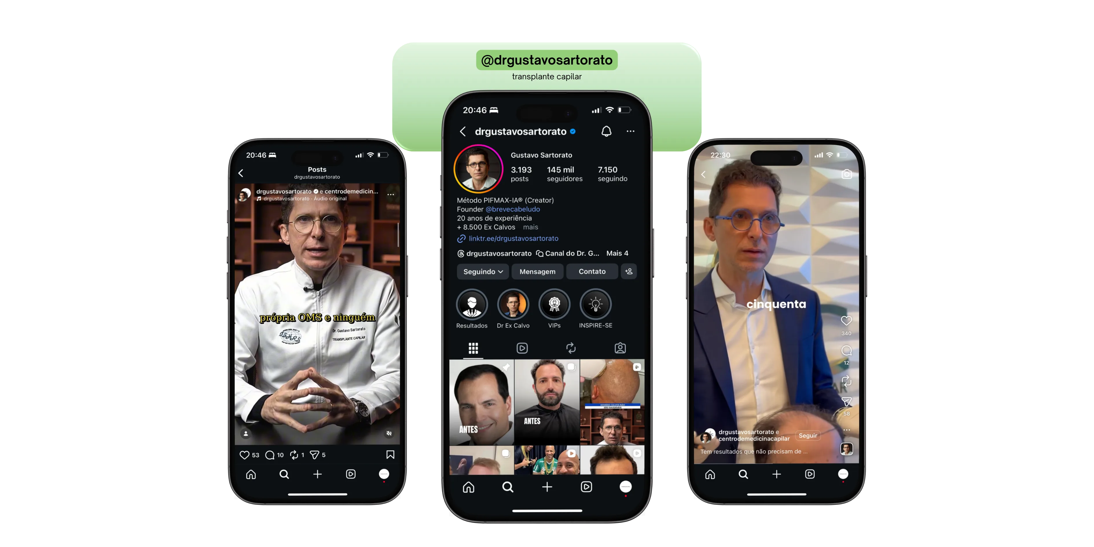 @drgustavosartorato - Transplante capilar